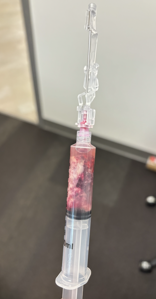 Breast tissue after massage